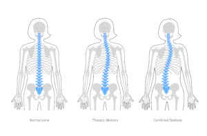 myths about scoliosis busted