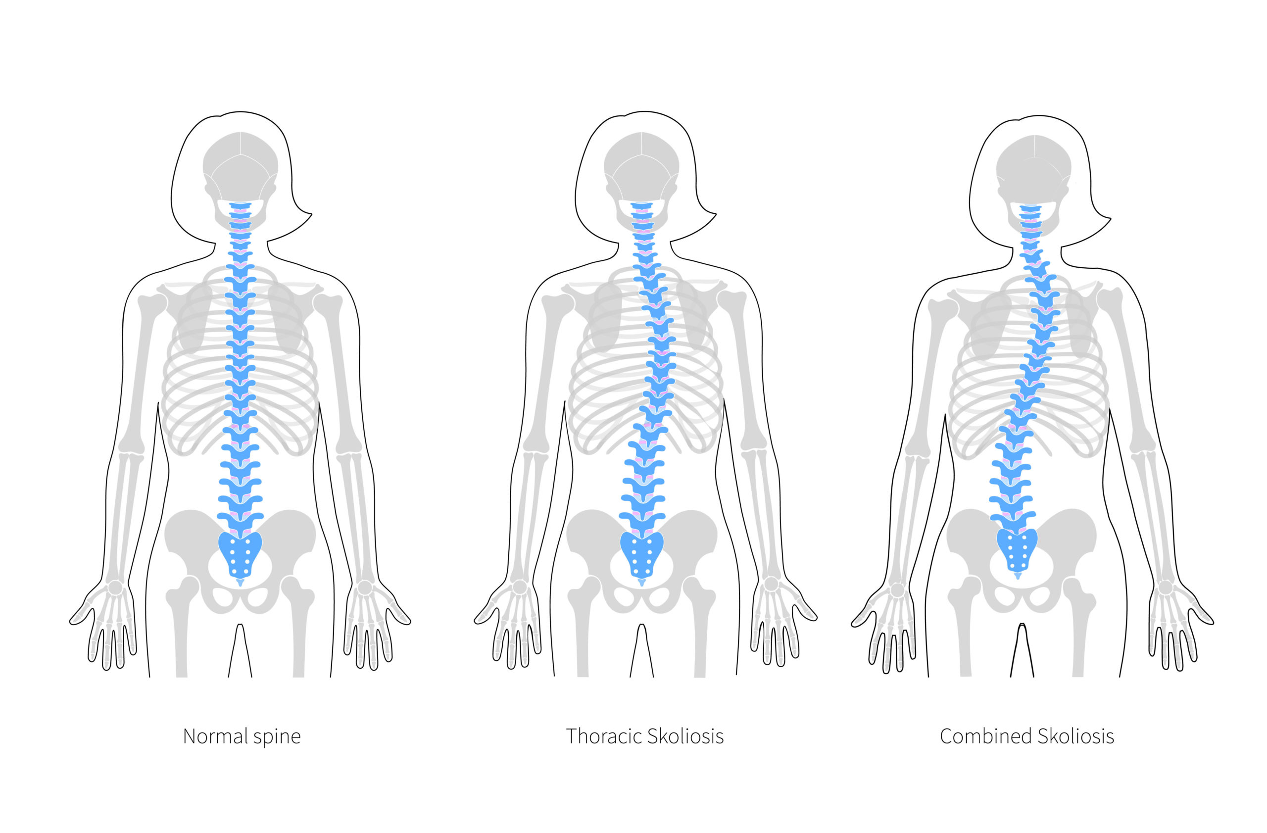 myths about scoliosis busted