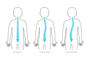 scoliosis types, symptoms and treatment