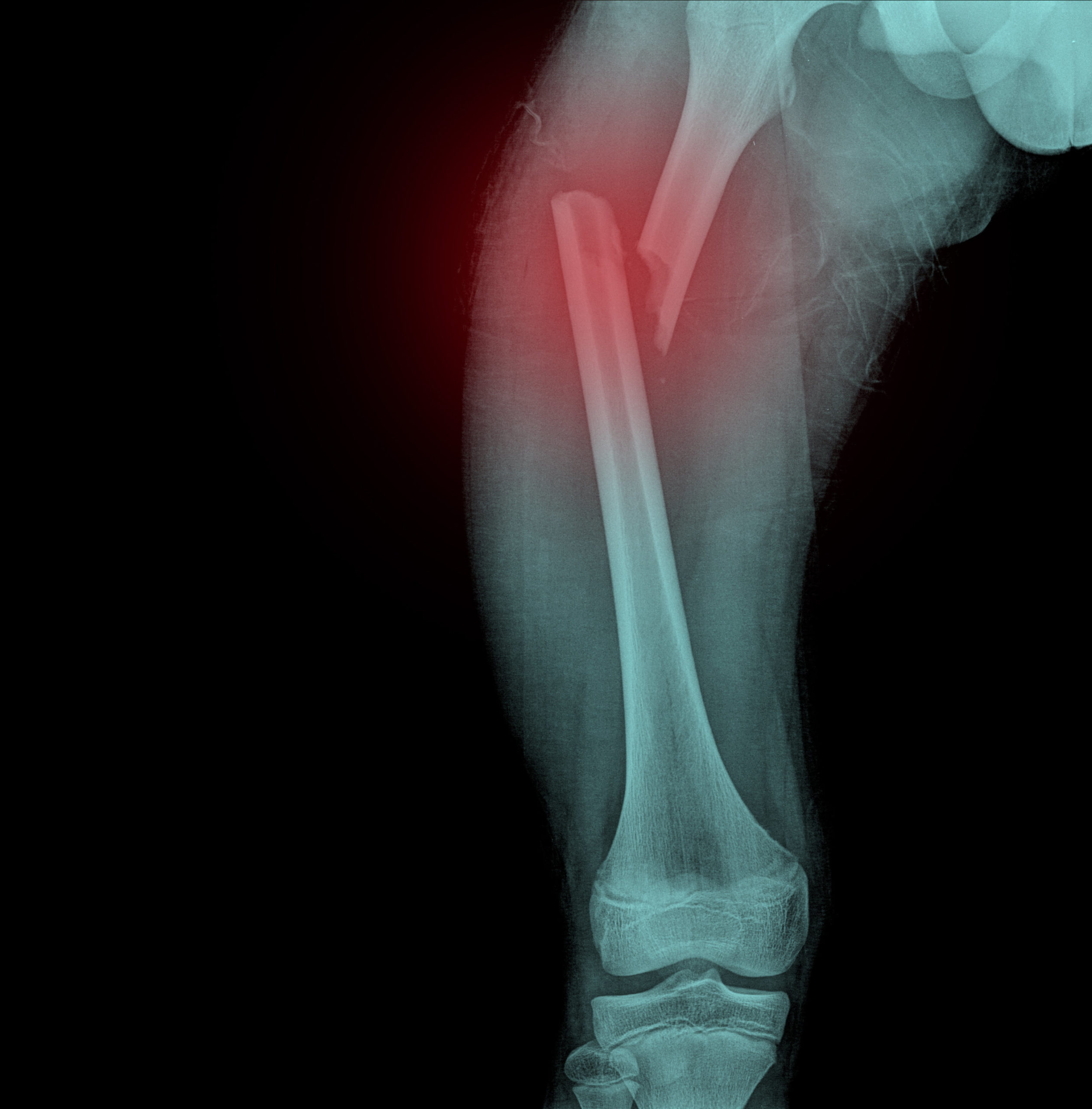 How Long Does Femur Surgery Take To Heal