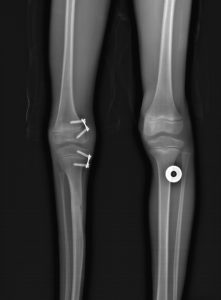 8plate on femur and tibia