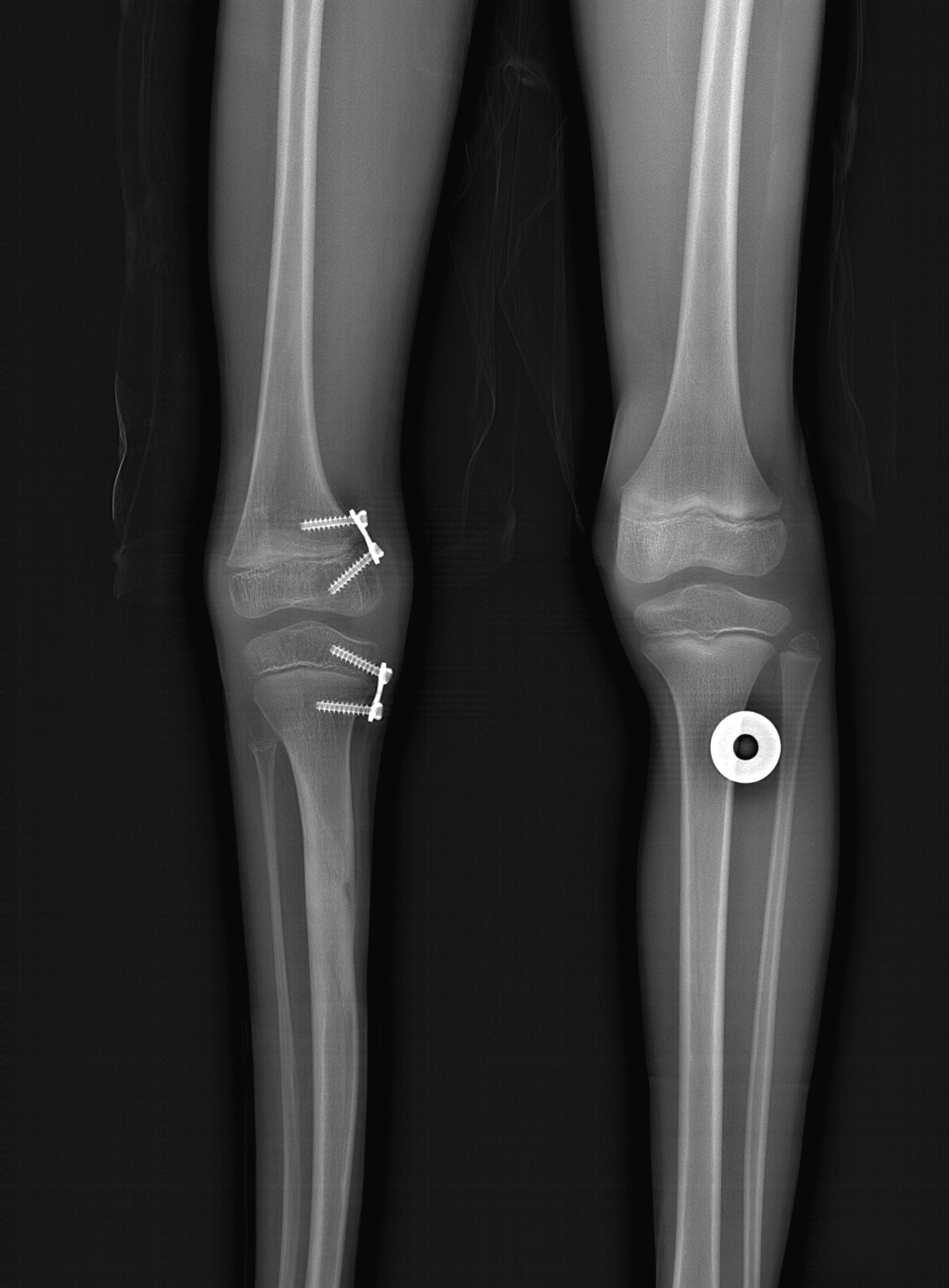 8plate on femur and tibia