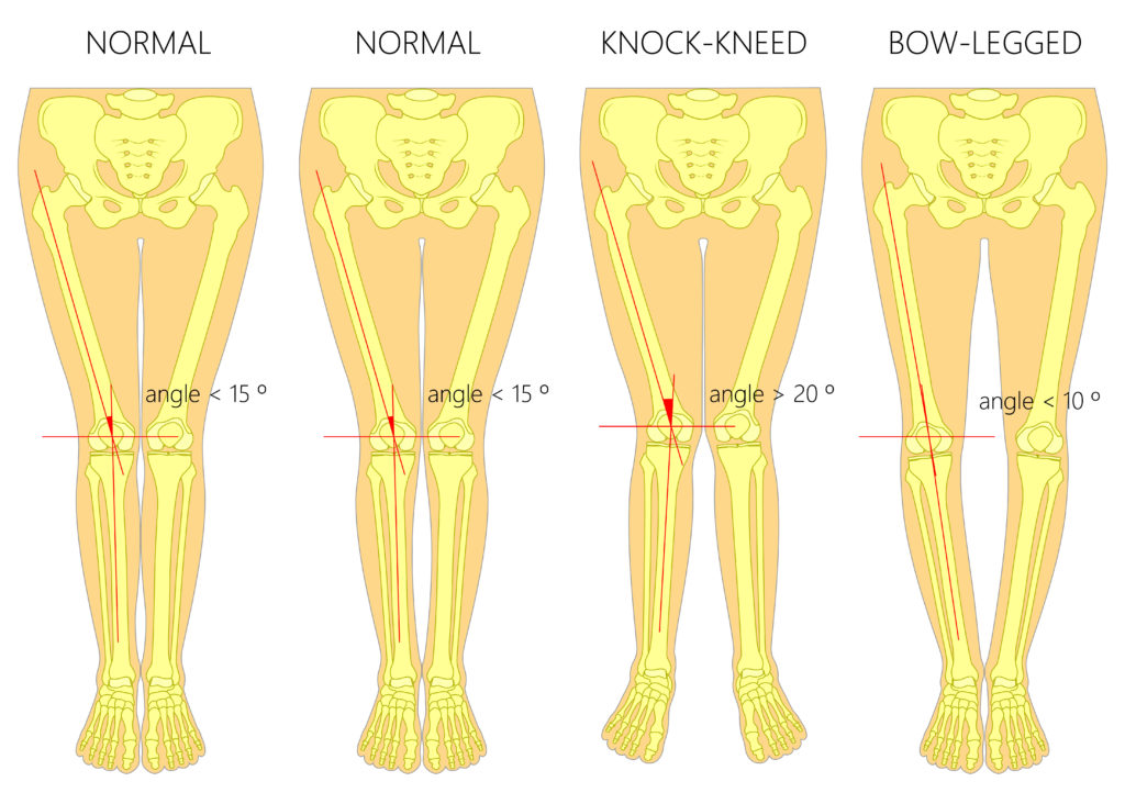 variations of knee angulations
