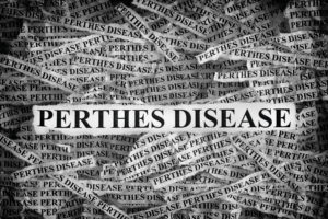 perthes disease