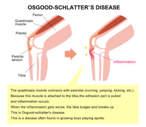 Osgood schlatter disease