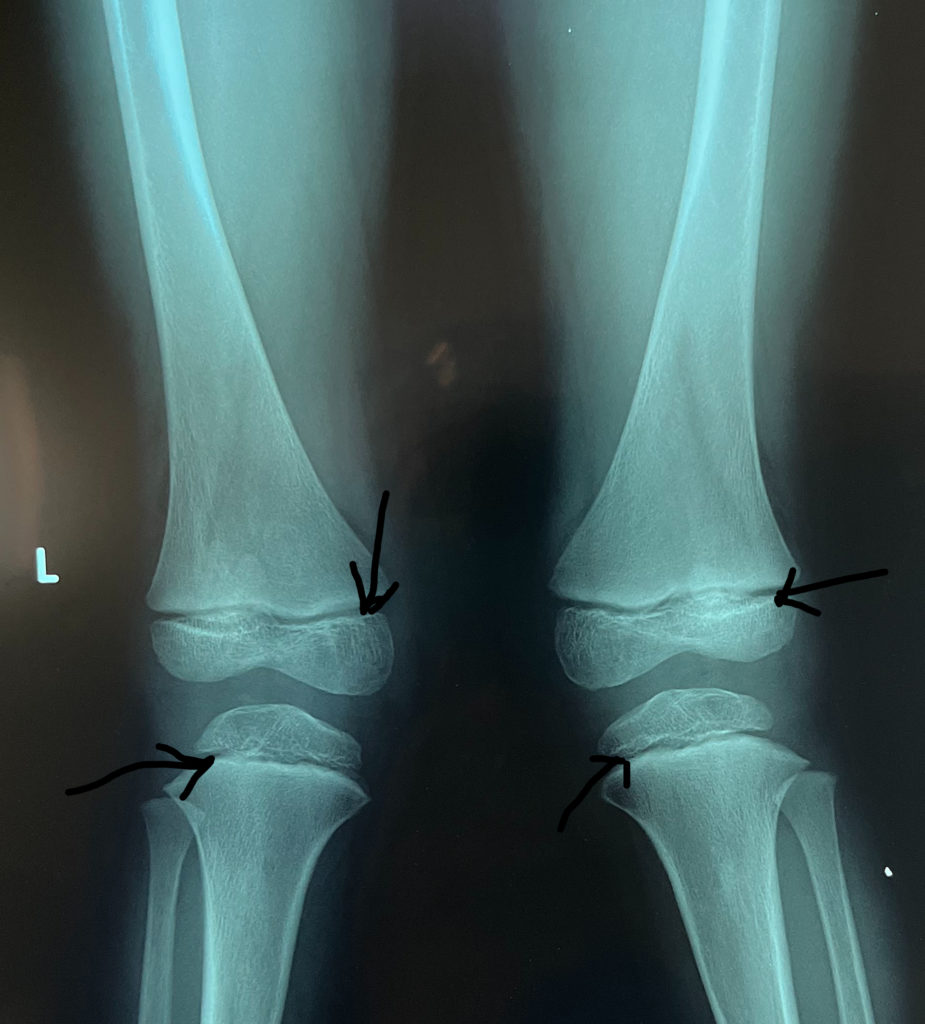 xray of child's bone with arrow pointing to  growth plate