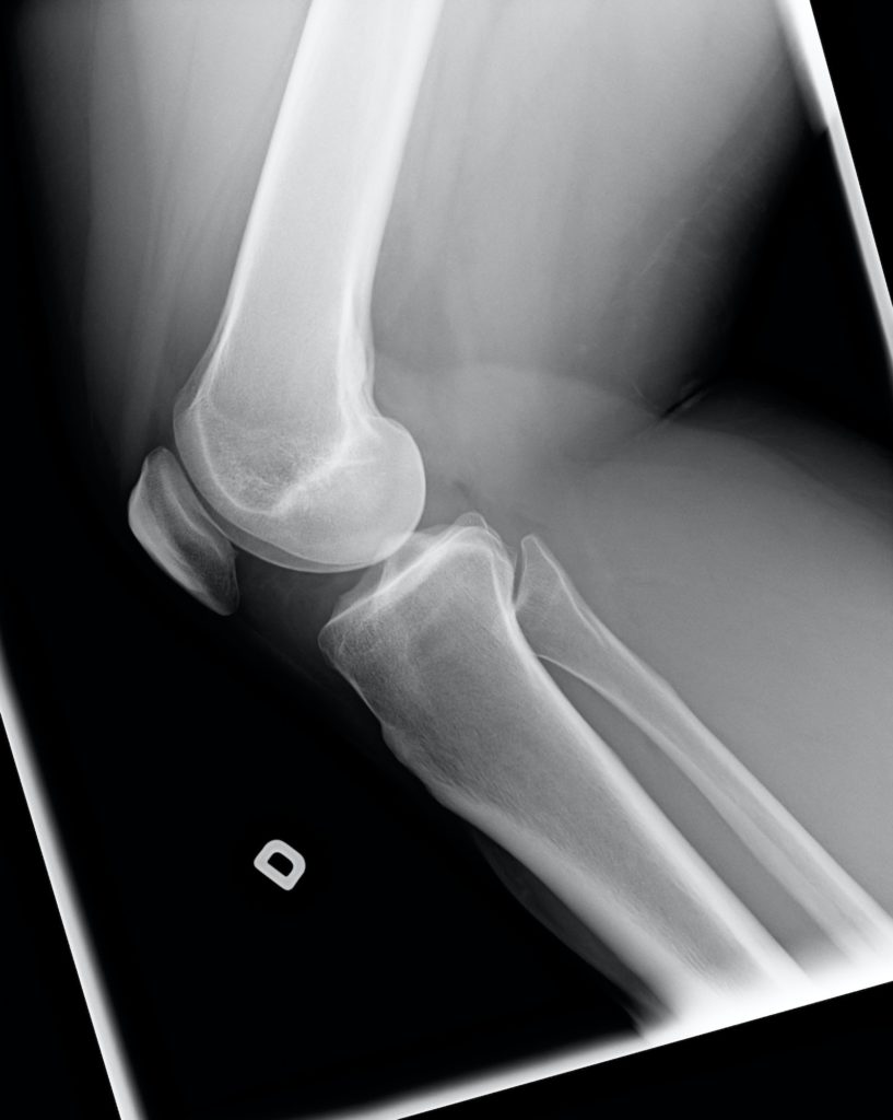 X-ray of knee with Chondromalacia condition